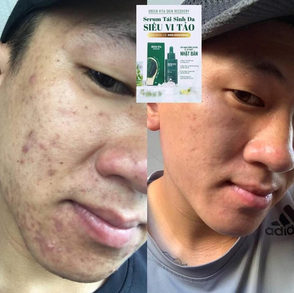 Sản phẩm Thạch dứa giảm cân...